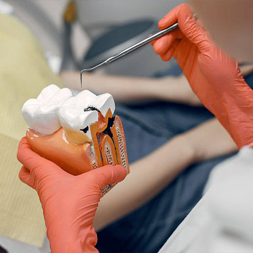 Dental Fillings