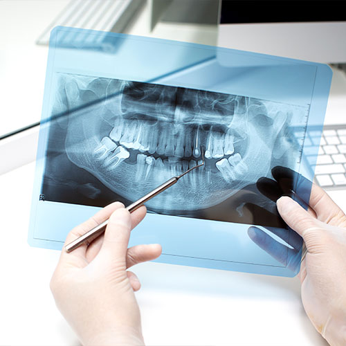 Root Canal Treatment 