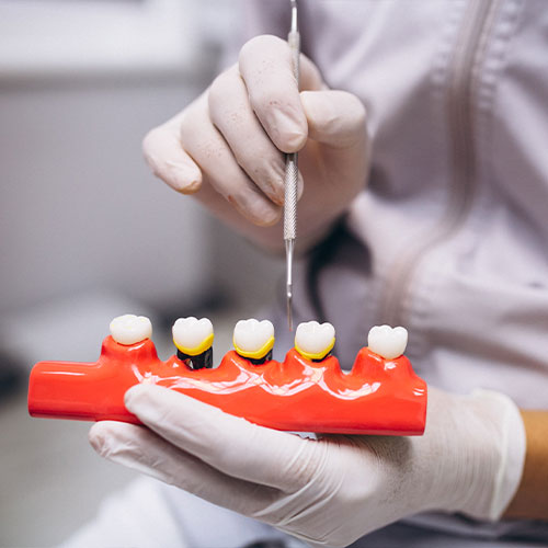 Dental Crowns & Bridges