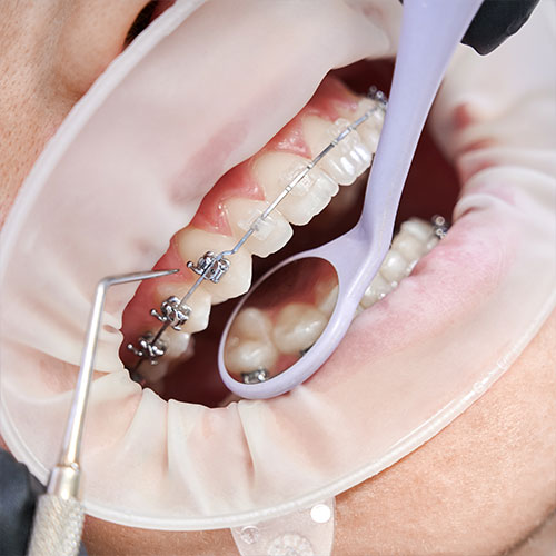 Invisalign & Braces