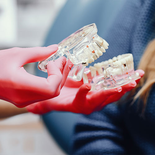 Dental Implants